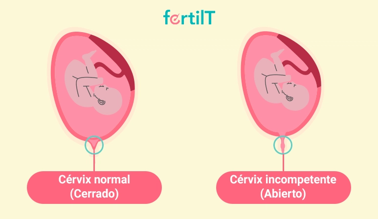 Imagen de dos embriones comparando uno en un cérvix normal y otro en un cérvix con incompetencia cervical