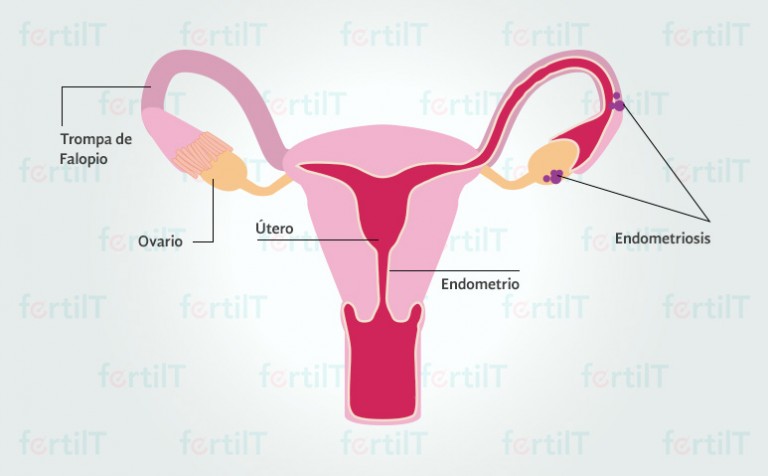 Endometriosis Definición Síntomas Y Tratamiento 5312