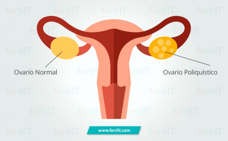 Síndrome De Ovarios Poliquísticos Sop Causas Síntomas Y Tratamiento 9078