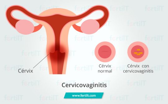 Cervicovaginitis qué es síntomas y tratamiento