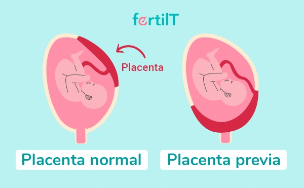 Placenta previa y placenta normal en infografía